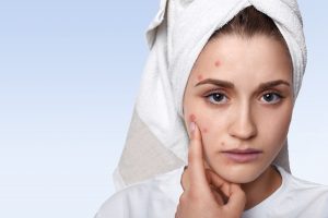 6 Effective Ways to Prevent Acne