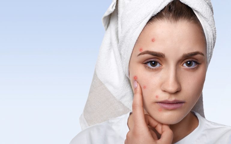6 Effective Ways to Prevent Acne